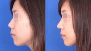 2024年長(zhǎng)沙權(quán)威整形醫(yī)院指南：隆鼻選亞韓，隆胸選do胸