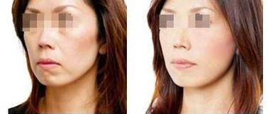 2024珠海雙眼皮手術醫(yī)院推薦，幫您預測前五家