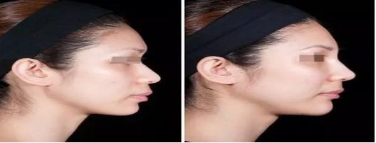 廣州哪家整形醫(yī)院祛痘效果比較好？去痘患者首選醫(yī)院排行榜