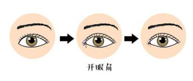 如何選擇適合自己的雙眼皮手術(shù)方法？