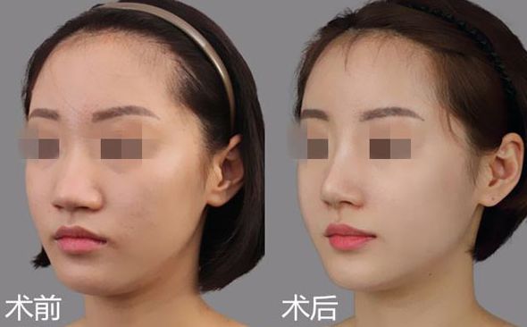 江門哪家醫(yī)院割雙眼皮效果好？