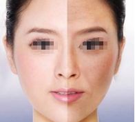 成都做韓式雙眼皮手術哪家醫(yī)院效果最好