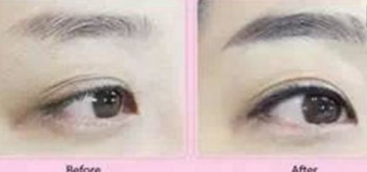 快速消腫！雙下巴吸脂術(shù)后恢復(fù)時(shí)長揭秘