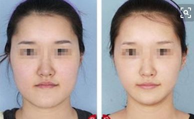 鄭州眼睛修復(fù)哪家醫(yī)院效果好