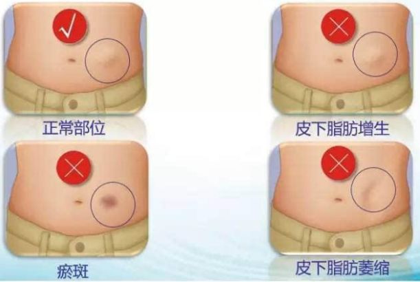 獲悉四川地區(qū)專業(yè)自體脂肪隆胸醫(yī)院，解決您的疑慮