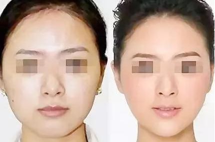 長沙哪個醫(yī)院做雙眼皮最好？