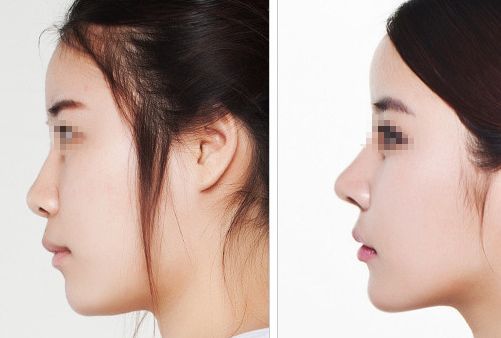 汕頭名流整形醫(yī)院：拉雙眼皮、吸脂價(jià)格一覽，專家解讀真實(shí)案例