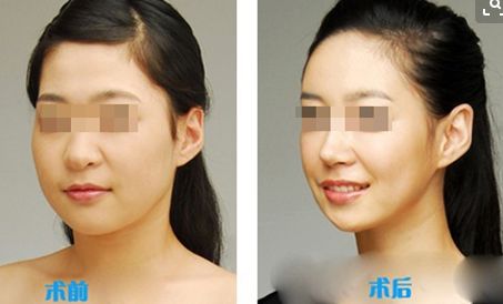 面部脂肪室復(fù)位術(shù)和埋線提升手術(shù)：價格及區(qū)別比較