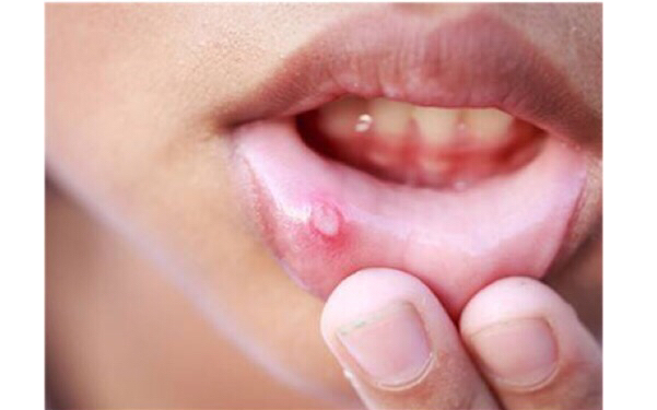 煙臺(tái)祛毛孔點(diǎn)陣激光醫(yī)生