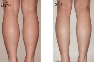 上海玻尿酸祛面部皺紋醫(yī)生