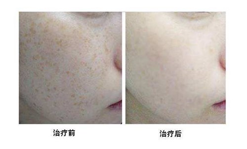 十堰微創(chuàng)手術(shù)去生長(zhǎng)紋醫(yī)生