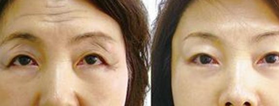 廣州超聲法去眼袋手術醫(yī)生