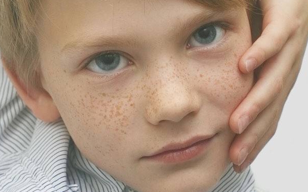 泰安鮮紅斑痣去除醫(yī)生