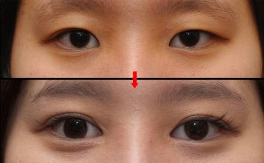 佛山大腿吸脂瘦腿醫(yī)生