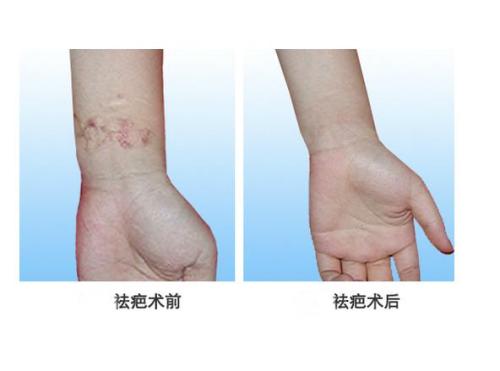 上海晶塑去痘印醫(yī)生