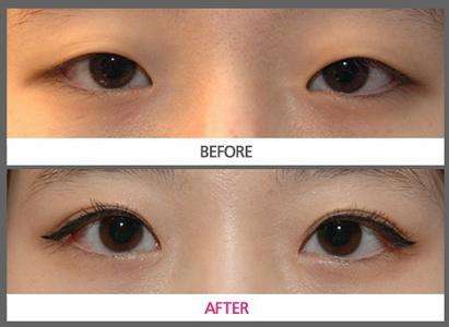 烏魯木齊長痘點陣激光醫(yī)生