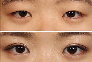 南京微創(chuàng)眼睛細(xì)紋手術(shù)醫(yī)生