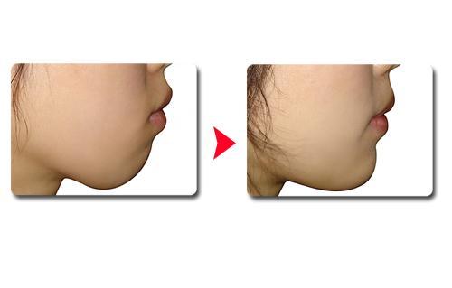 2023年上海市哪家醫(yī)院是最受網(wǎng)友認(rèn)可的做隆胸整形醫(yī)院？排名前六強(qiáng)！