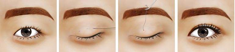 2023年天津公立醫(yī)院雙眼皮手術(shù)排名及網(wǎng)友好評！