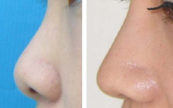 珠海眼上魚(yú)尾紋醫(yī)生