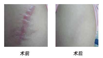 寧波口周紋激光去除醫(yī)生