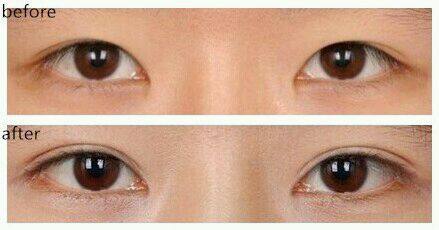 河南微創(chuàng)眉間紋手術醫(yī)生