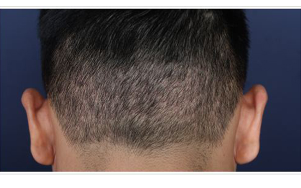 南京脫發(fā)治療中心評(píng)價(jià)匯總前四：擁有健康華麗的秀發(fā)，告別頭頂稀疏~