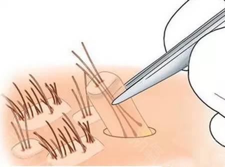 全國著名植發(fā)醫(yī)院排行榜！推薦您前往上海九院、新生等頂級機(jī)構(gòu)