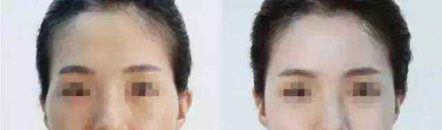 蘭州頂級整容醫(yī)院排行榜：讓你安心整形，保障你的雙眼皮手術(shù)結(jié)果！