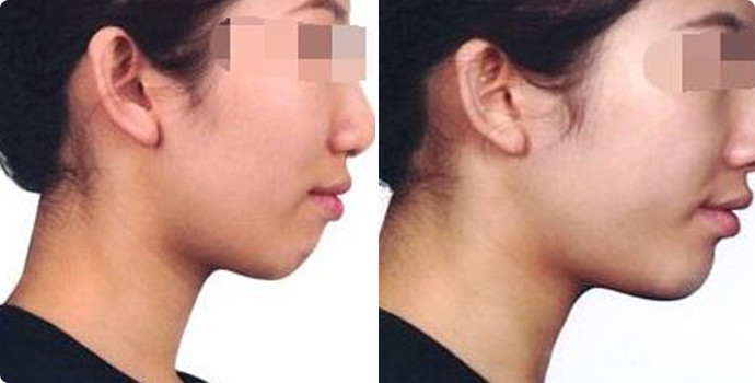 常州雙眼皮整形醫(yī)院精選六家頂級(jí)醫(yī)院，詳情提前公布！