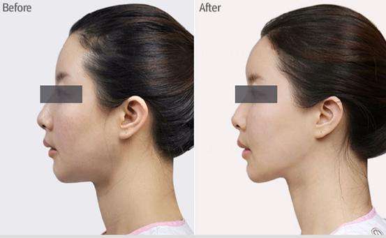 寧波哪家醫(yī)院的拉皮手術(shù)技術(shù)獨(dú)步全市？精選的前五醫(yī)院名單，藝星、薇琳等都上榜！