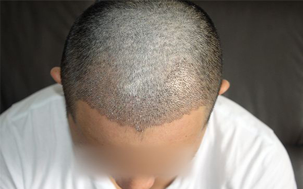 廣州哪家雙眼皮醫(yī)院技術(shù)一流？這兩家醫(yī)院贊譽(yù)度超高！