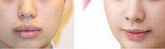 成都激光脂肪填充醫(yī)院推薦排行榜：軍大、華美、瑪麗亞奪冠！愛美者贊不絕口，美容圣地值得珍藏！