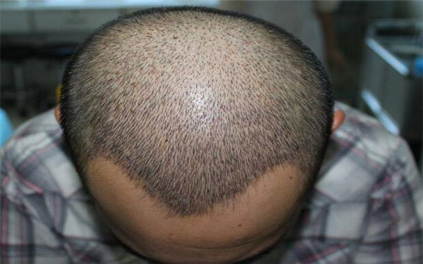 徐州雙眼皮修復(fù)醫(yī)院前五強(qiáng)：曙光、華美上榜！