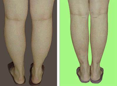 石家莊激光祛動態(tài)細紋醫(yī)生