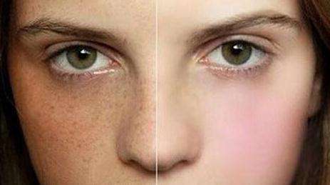 湖南生長紋填充玻尿酸醫(yī)生