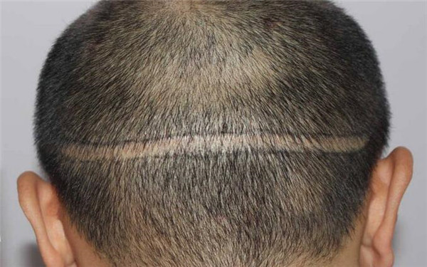 2023年天津黑眼圈治療醫(yī)院推薦，看看那位醫(yī)生的技術(shù)厲害