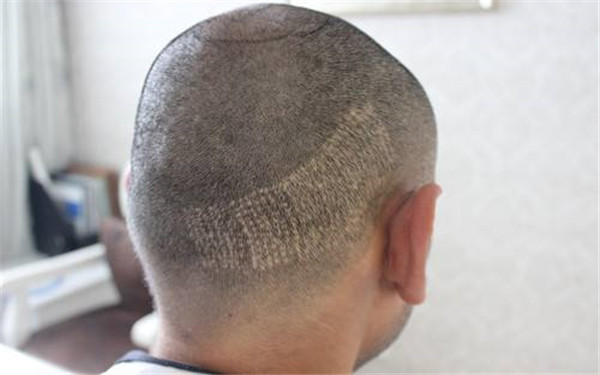 2023年臨汾魚尾紋嗨體填充美容醫(yī)院口碑排行榜發(fā)布！最受青睞的魚尾紋填充醫(yī)療中心揭秘！