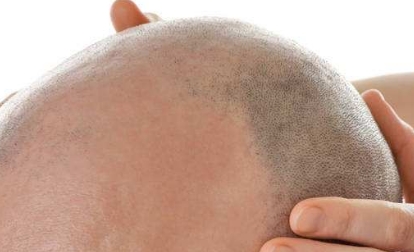 2023年十大口碑好的深圳水光針去眼底紋整形醫(yī)院揭秘！