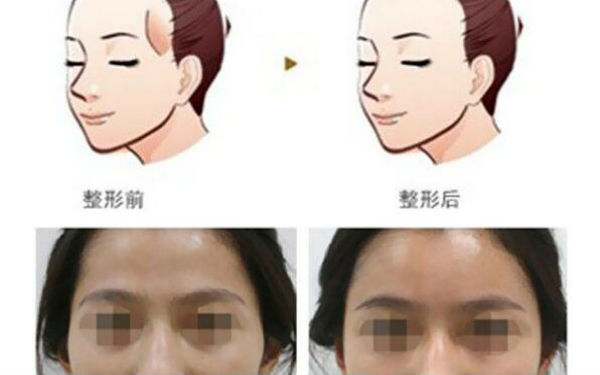 洛陽(yáng)哪家醫(yī)院做木偶紋效果好？2023榜單出爐，洛陽(yáng)物理去木偶紋top10佳選露面！