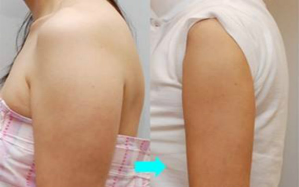 天津哪些整形美容醫(yī)院提供卓越的線雕去眼紋技術？2023比較推崇的天津線雕去眼紋前十佳整形醫(yī)院盤點！