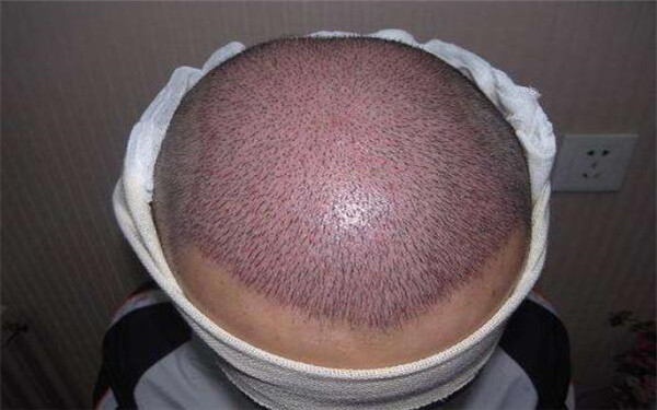 2023年，首都北京哪家醫(yī)院比較推崇，能夠有效去除印第安紋？