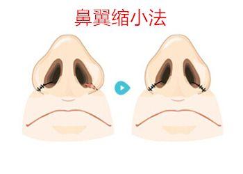 2023重慶乳房下垂矯正醫(yī)院推薦！效果好的前十強(qiáng)榜單曝光！