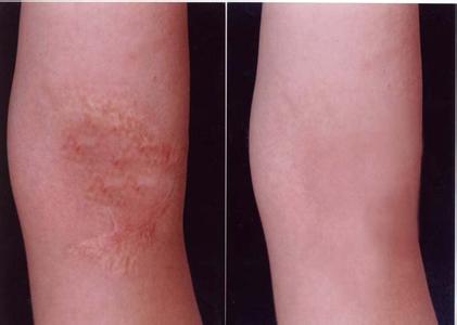 沈陽(yáng)面下2/3除皺醫(yī)生