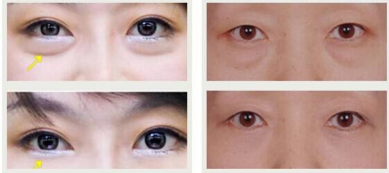 東莞有哪些效果好的川字紋除皺醫(yī)院？2023年東莞十大正規(guī)醫(yī)院排行榜出爐！