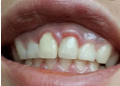 黃石哪家醫(yī)院能填充太陽(yáng)穴假體？2023黃石太陽(yáng)穴美容前十有哪些好選擇！