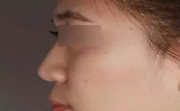 2023年海口射頻微針去眼角細(xì)紋哪個(gè)醫(yī)院比較好？?？谘劢羌?xì)紋整形美容醫(yī)院排行榜綜合報(bào)道！