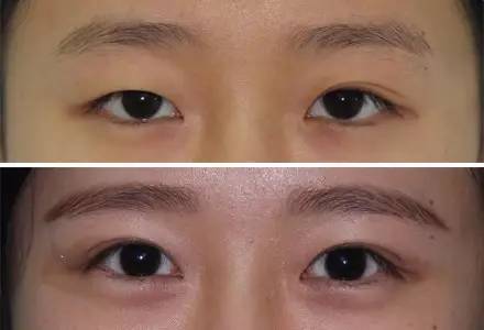 杭州駝峰鼻矯正哪家整形醫(yī)院技術(shù)獨(dú)特？2023杭州駝峰鼻矯正排名前10的醫(yī)院評測揭曉！