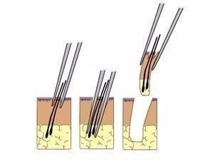 2023鄭州哪家整形醫(yī)院口碑好？眼角紋去除效果！