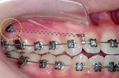 杭州哪家醫(yī)院做玻尿酸填充淚溝好？2023年排行榜公布！